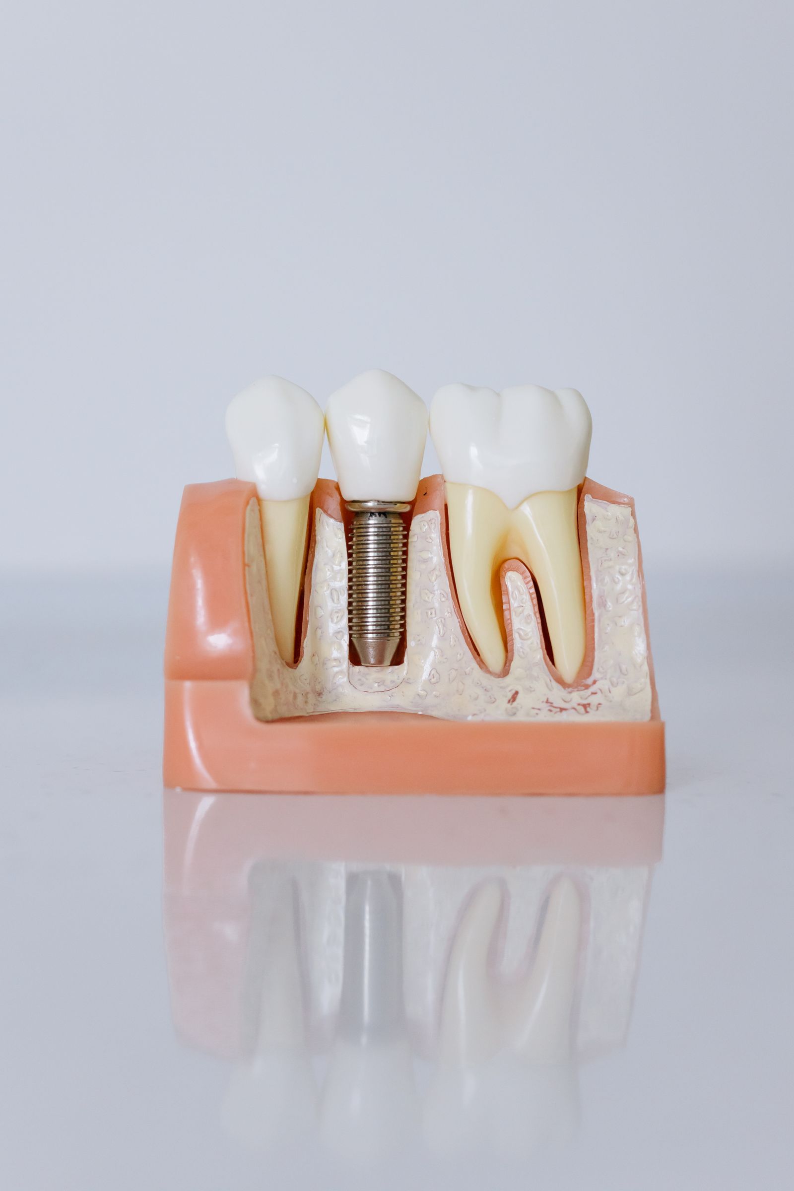 Modelo anatómico de implante dental