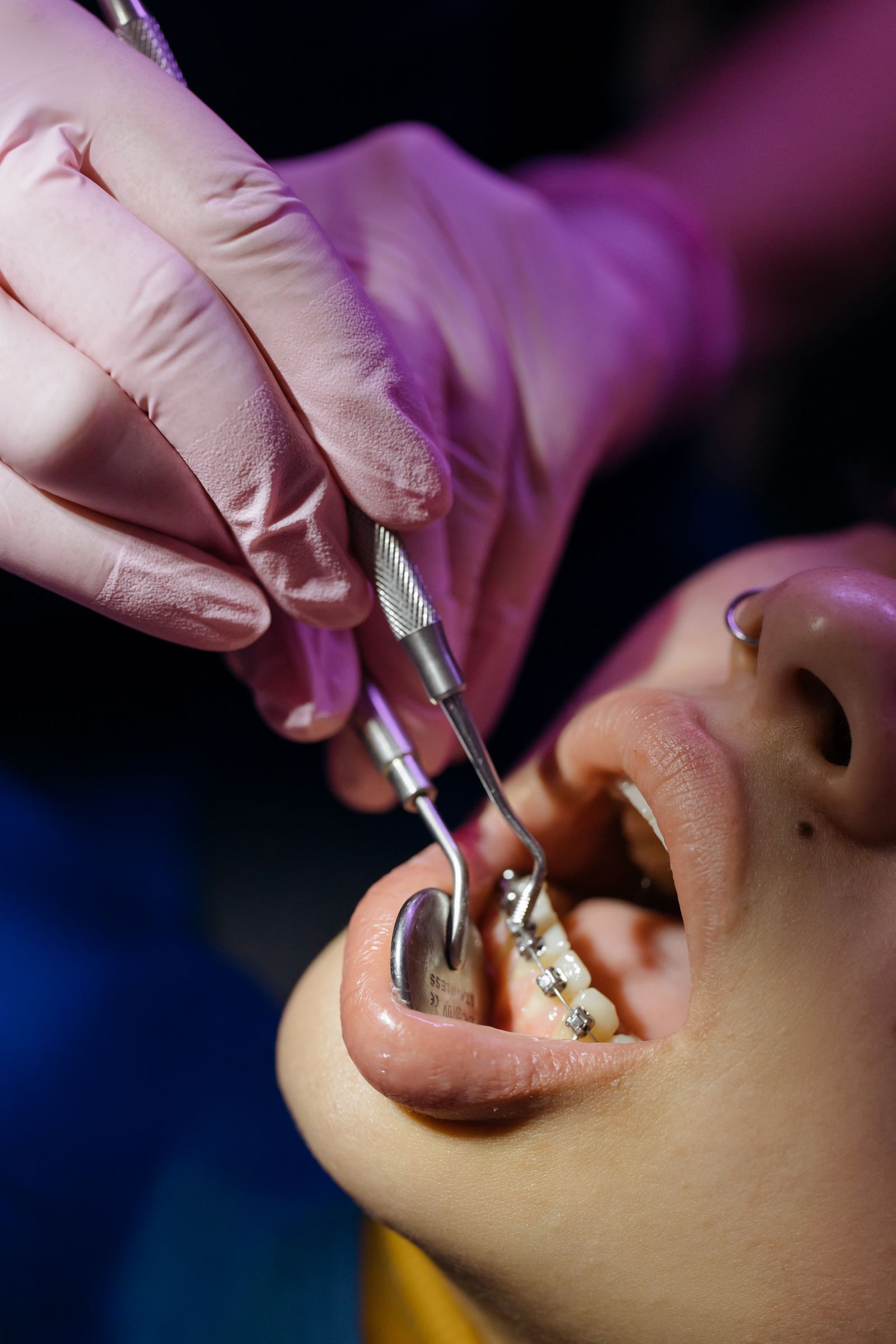 Tratamiento de brackets en consulta