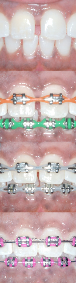 Secuencia de brackets cerrando un diastema
