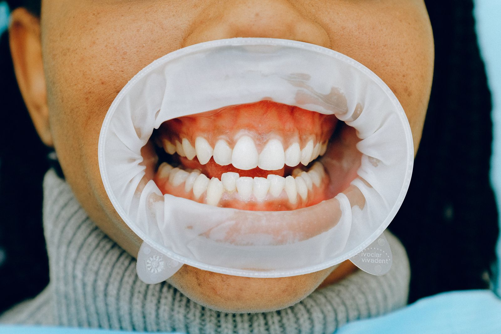 Estado clínico intraoral antes del diseño de sonrisa